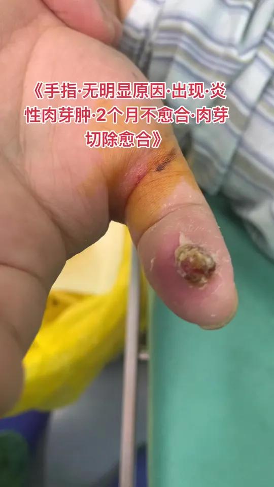 炎症肉芽肿可以长时间不能愈合,一碰就出血,对于轻度的可以局部换药去除肉芽,生长很大的慢性肉