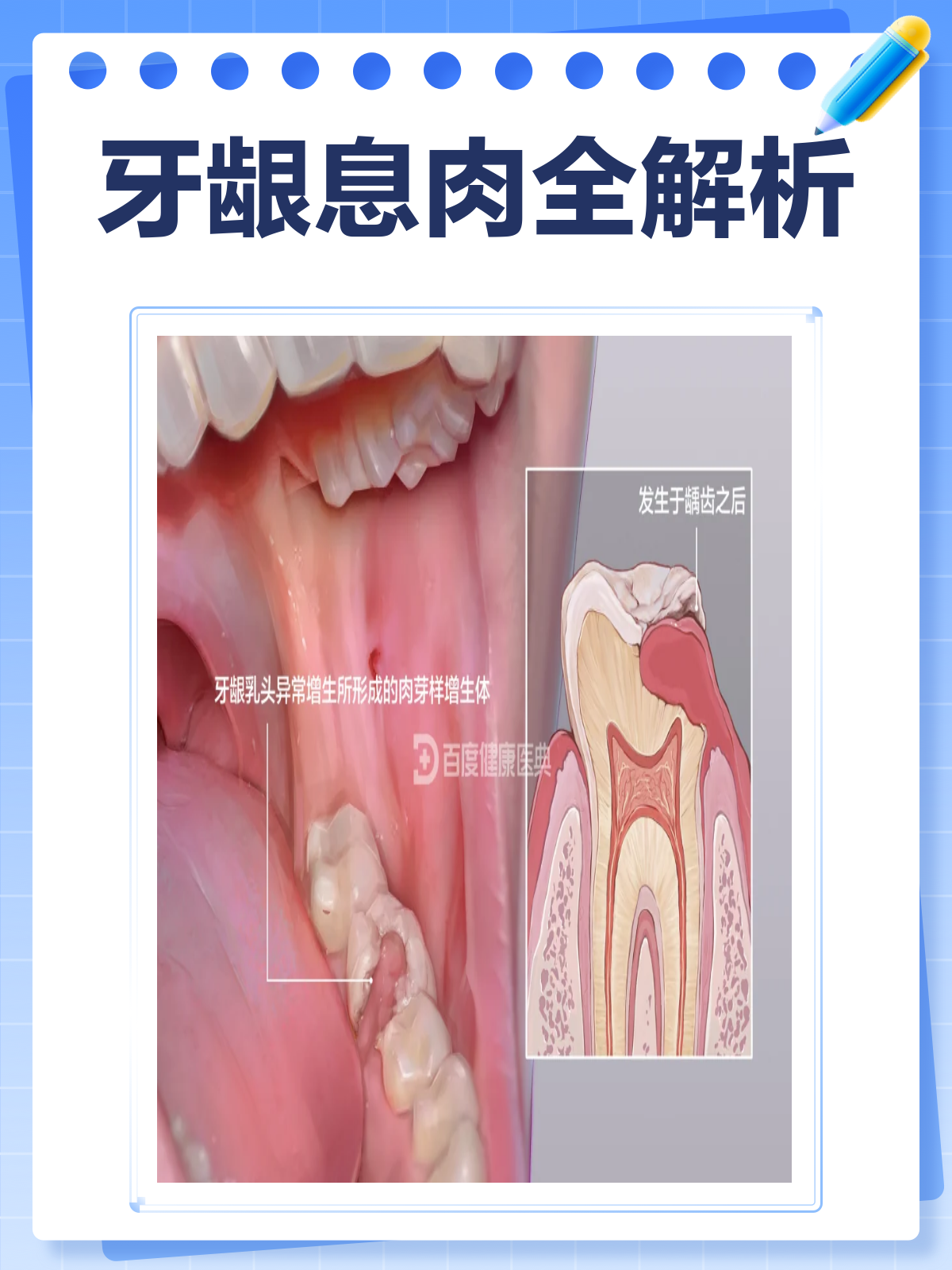 牙龈上的“不速之客”？揭秘牙龈息肉！
