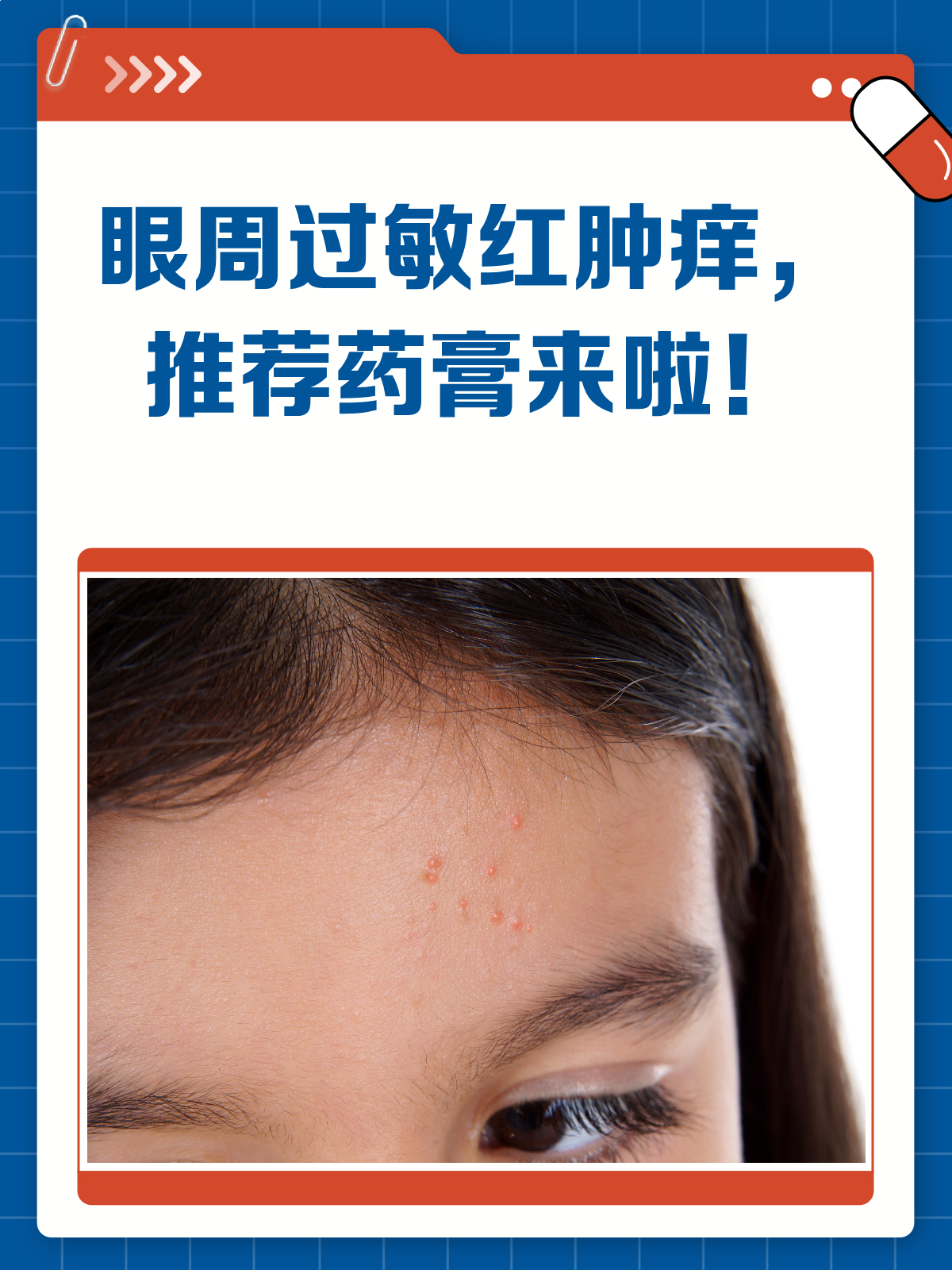 眼周过敏红肿痒？这些药膏来帮忙
