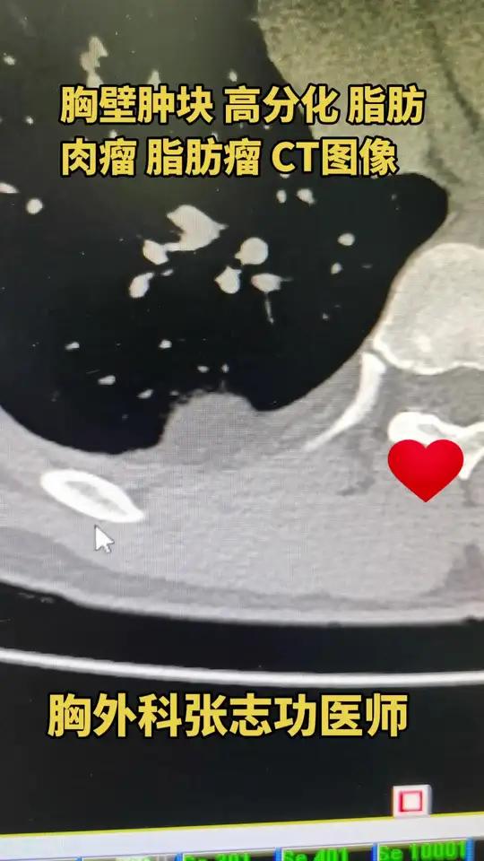 高分化脂肪肉瘤脂肪瘤CT图像,啥样