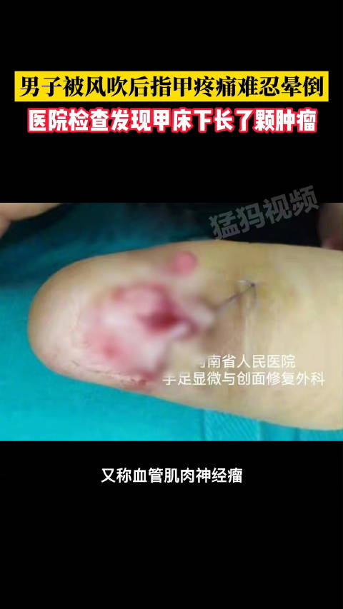 「男子指甲被风吹后疼的晕倒 医院检查发现甲床下长了个肿瘤」近日,河南郑州一男子右手食指突然