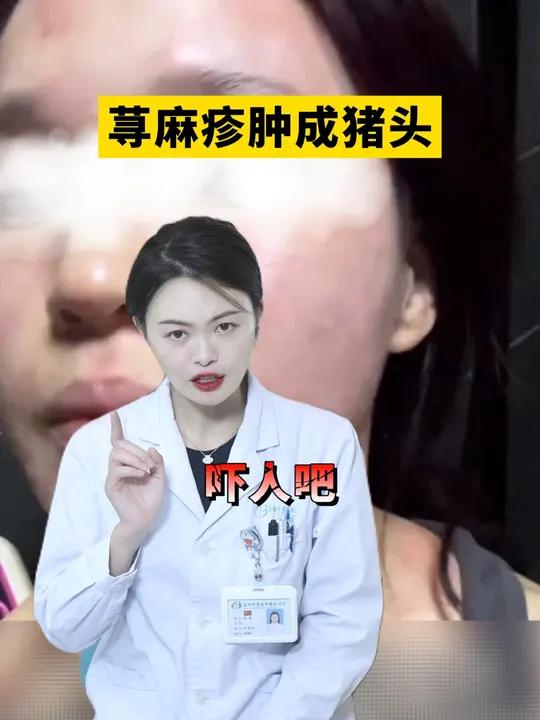 得了急性荨麻疹内脏都会起风团?别害怕,医生告诉你是怎么回事!