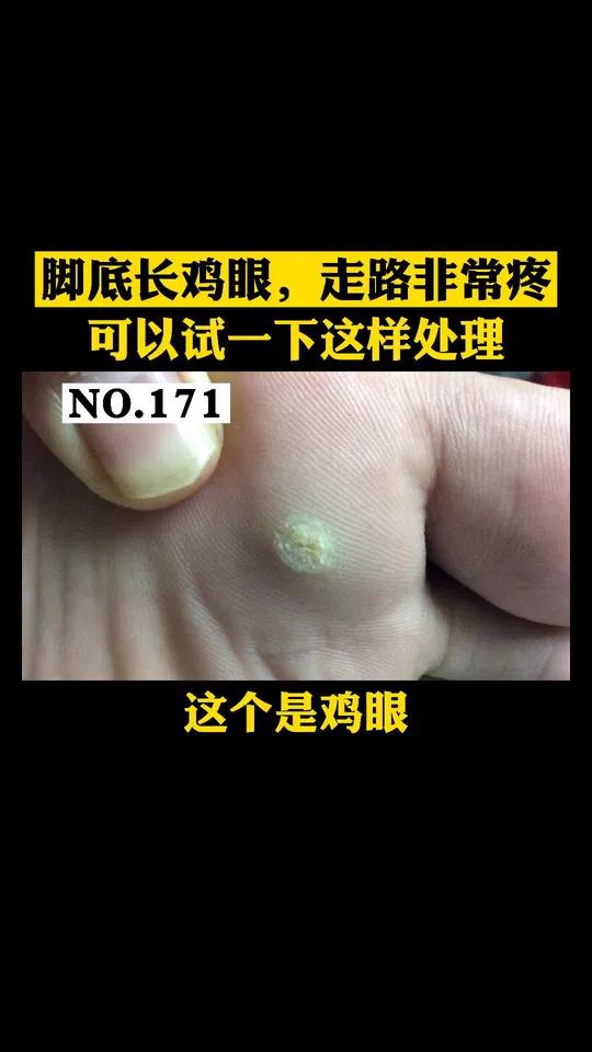 脚底长鸡眼,走起路来都疼,可以试一下这样处理