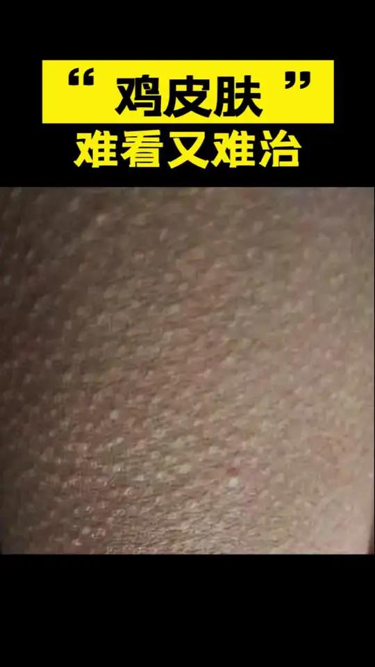 “鸡皮肤”难看又难治 怎么处理