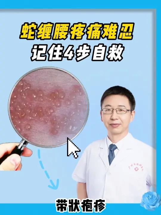 蛇缠腰带状疱疹疼痛难忍,医生教你处理分四步走