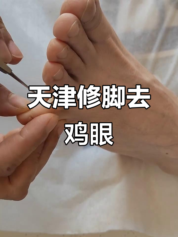 天津姐姐脚上长鸡眼,修脚大师妙招去除
