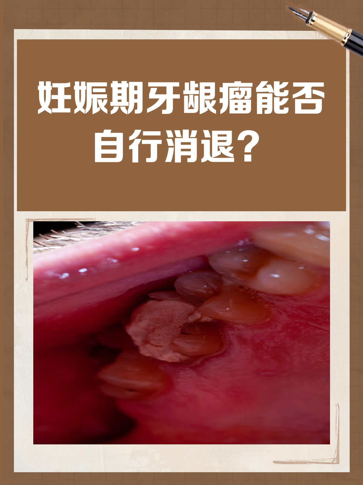 妊娠期牙龈长“肉坨”?别急,它可能会自己消失!