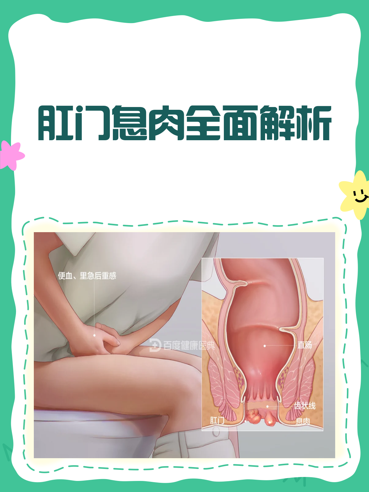 肛门息肉全解析:定义、症状与治疗