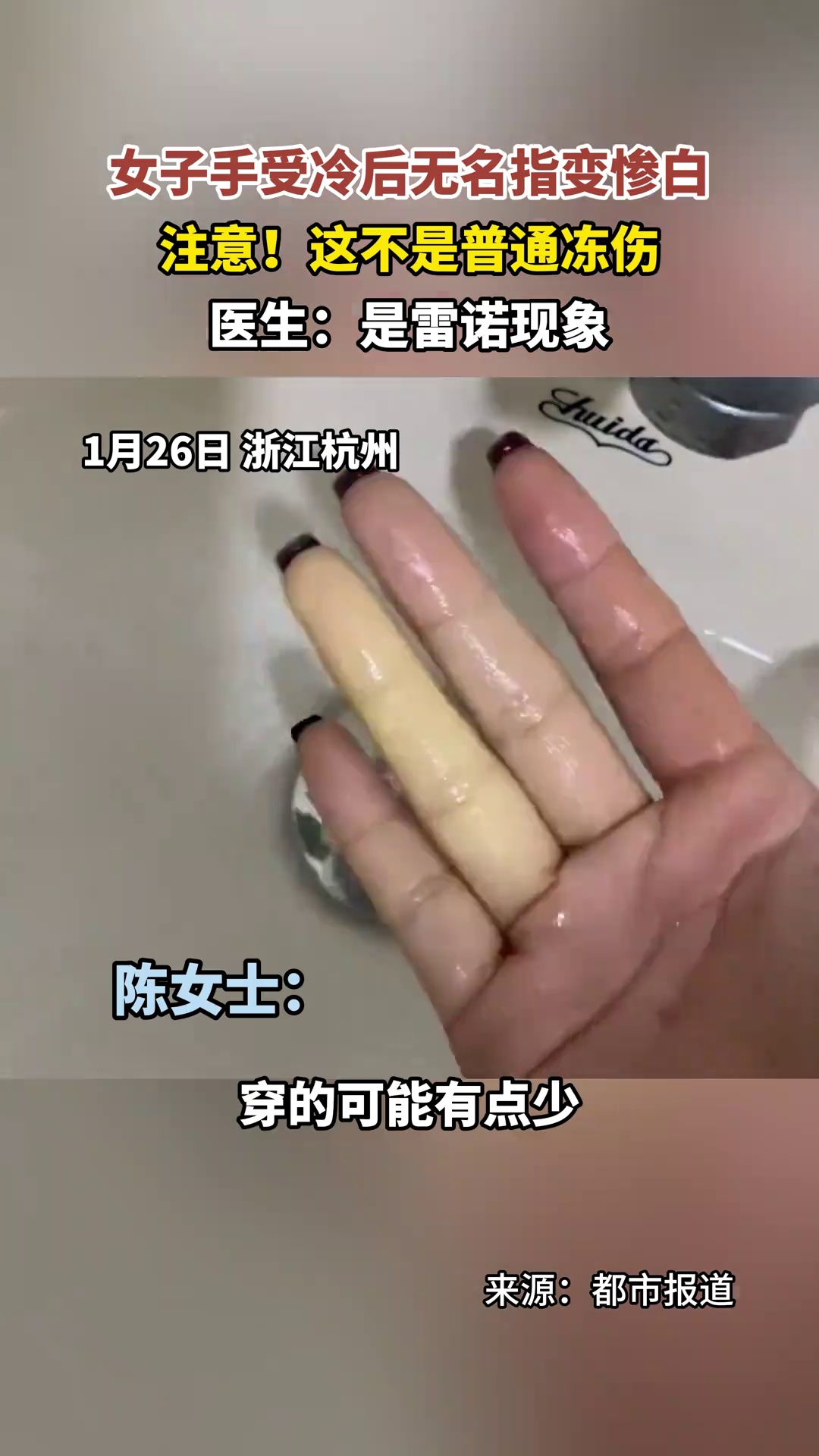 杭州一女子手指被冻后变惨白,医生:不是普通冻伤,是雷诺现象