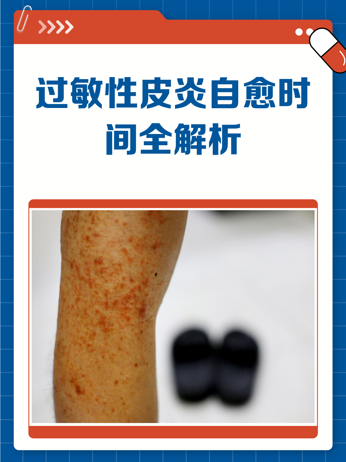 过敏性皮炎,多久能自愈?