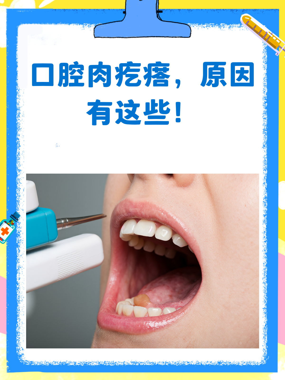 口腔里长肉疙瘩？别急，先看看这篇！