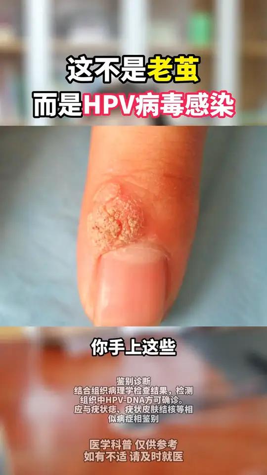 手上长小疙瘩,很多人以为是茧子或鸡眼,其实这个是hpv感染引起的寻常疣,这样处理才不会越长