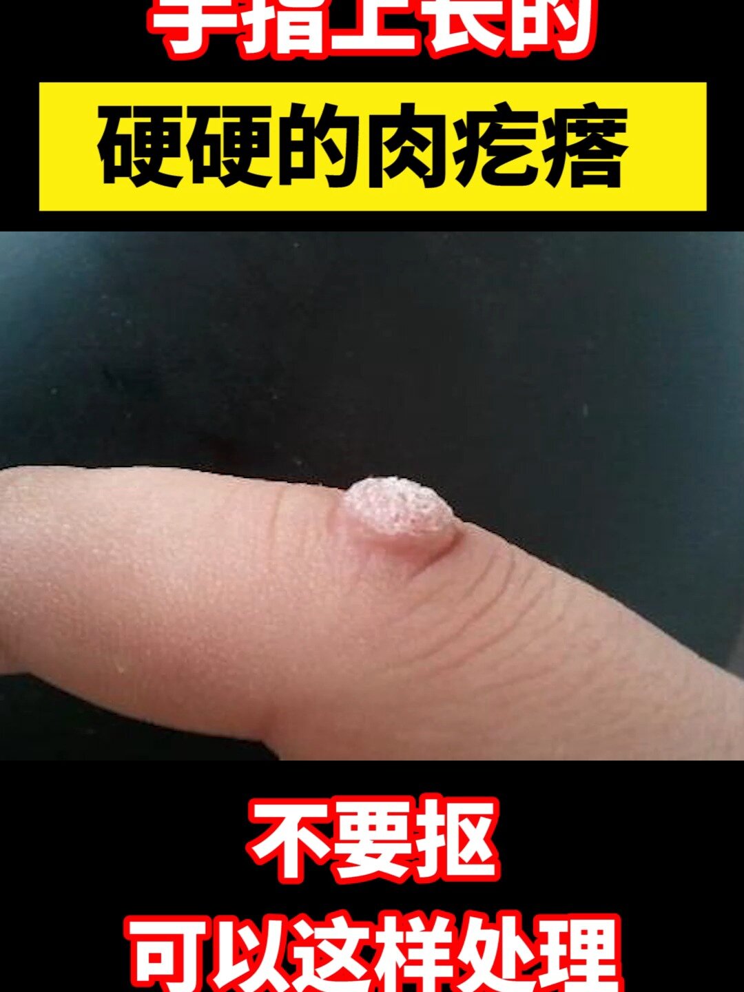 手指上长的硬硬的肉疙瘩 可以这样处理