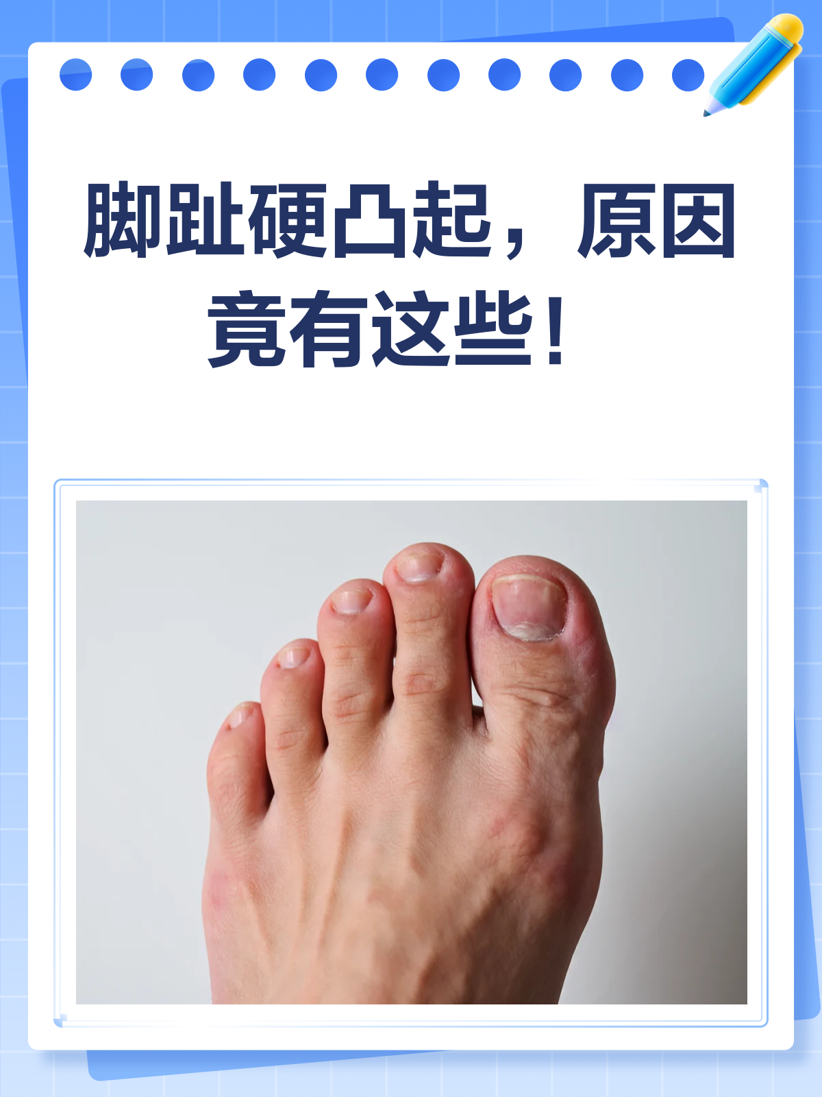 脚趾上的硬凸起?揭秘跖疣、鸡眼还是啥?