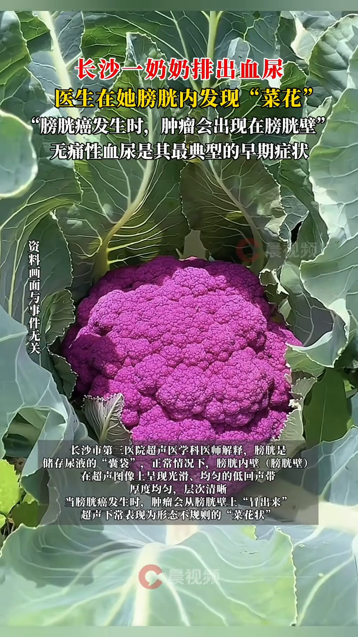 长沙一老人排出血尿，医生在她膀胱内发现“菜花”，确诊这个病