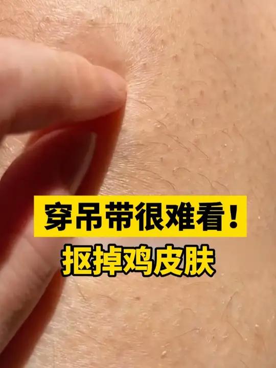 别抠胳膊大腿上的鸡皮肤了!嫌弃穿吊带难看?医生教你在家简单处理