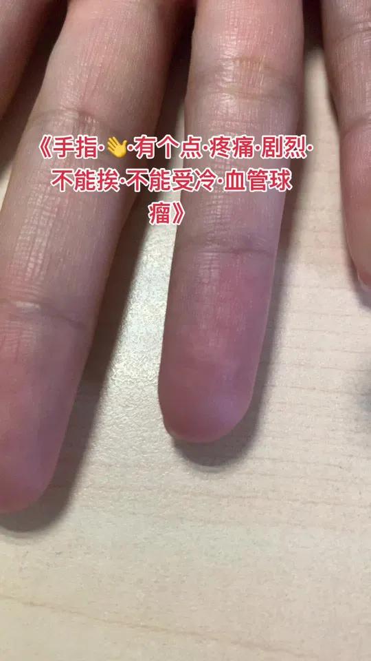 手指碰上去疼痛剧烈、不能忍受血管球瘤不是血管瘤血管球瘤的疼痛血管球瘤的疼痛是一种神经痛血管
