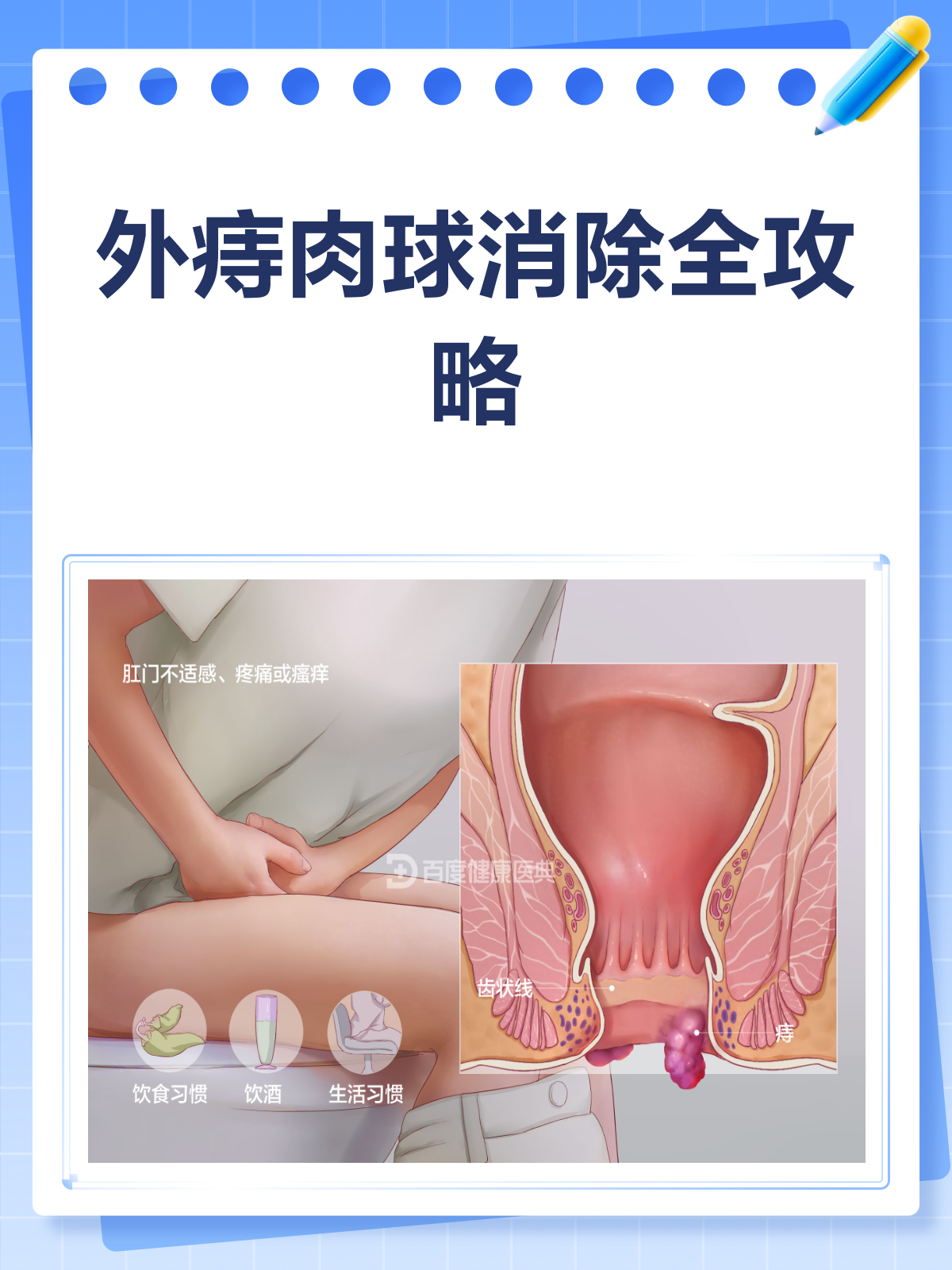 外痔肉球太烦人?多管齐下消痔有招!