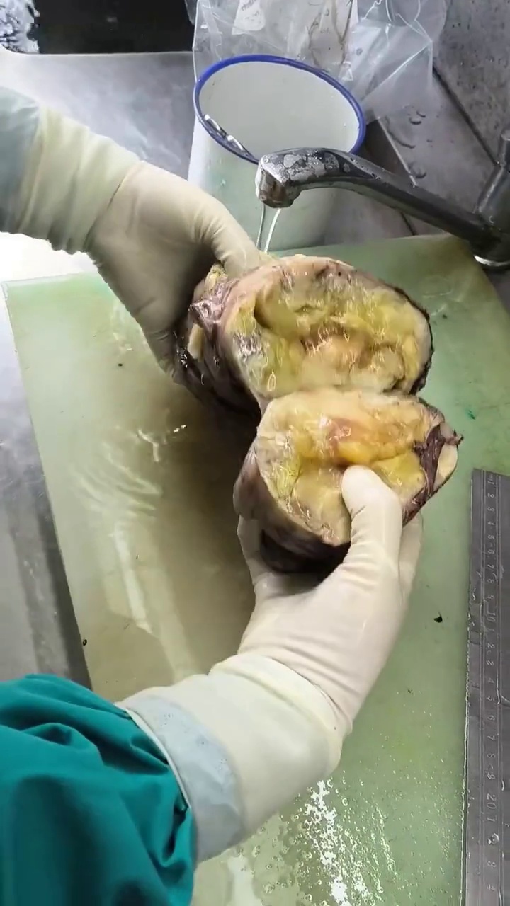 大腿粘液样脂肪肉瘤：无痛肿物生长快，复发转移严重需反复切除