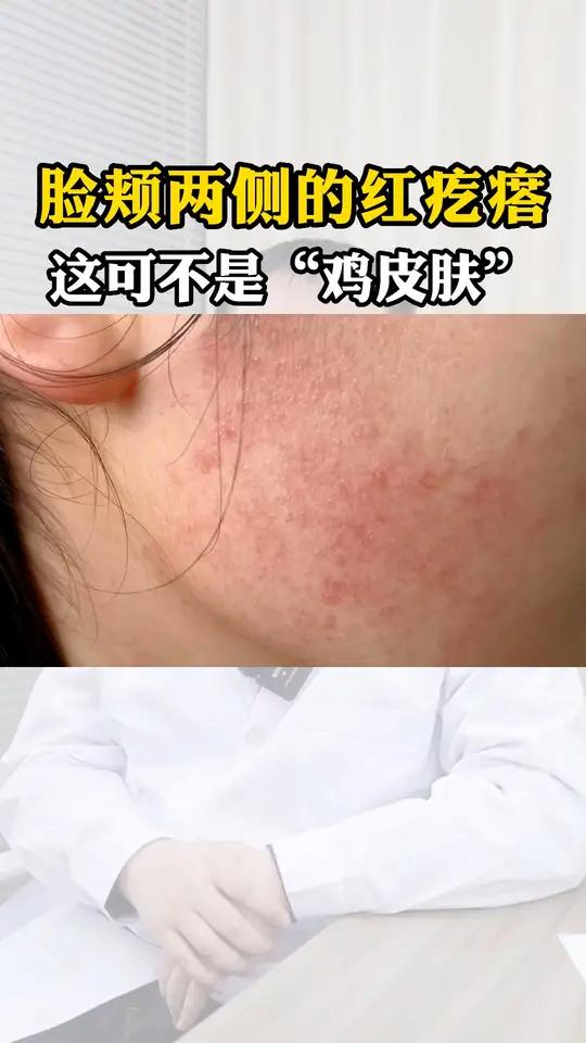 别再把脸上的这种小疙瘩当鸡皮肤了,其实这是毛囊红斑黑变病一般小孩容易长