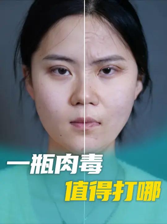 一百单位肉毒都值得打哪？肉毒 除皱针
