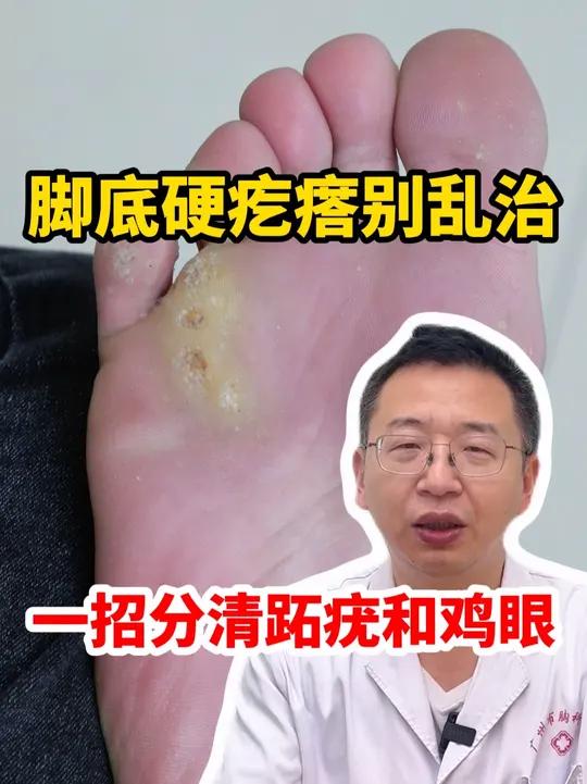 脚底硬疙瘩别乱治 一招分清鸡眼跖疣 #鸡眼 #跖疣 #跖疣如何有效去除 #抖出健康知识宝藏