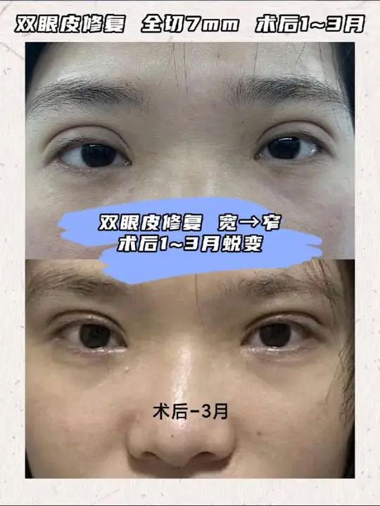 双眼皮修复 宽→窄 术后1～3月变化 双眼皮割太宽了怎么办,可以改善吗?双眼皮肉条感明显还