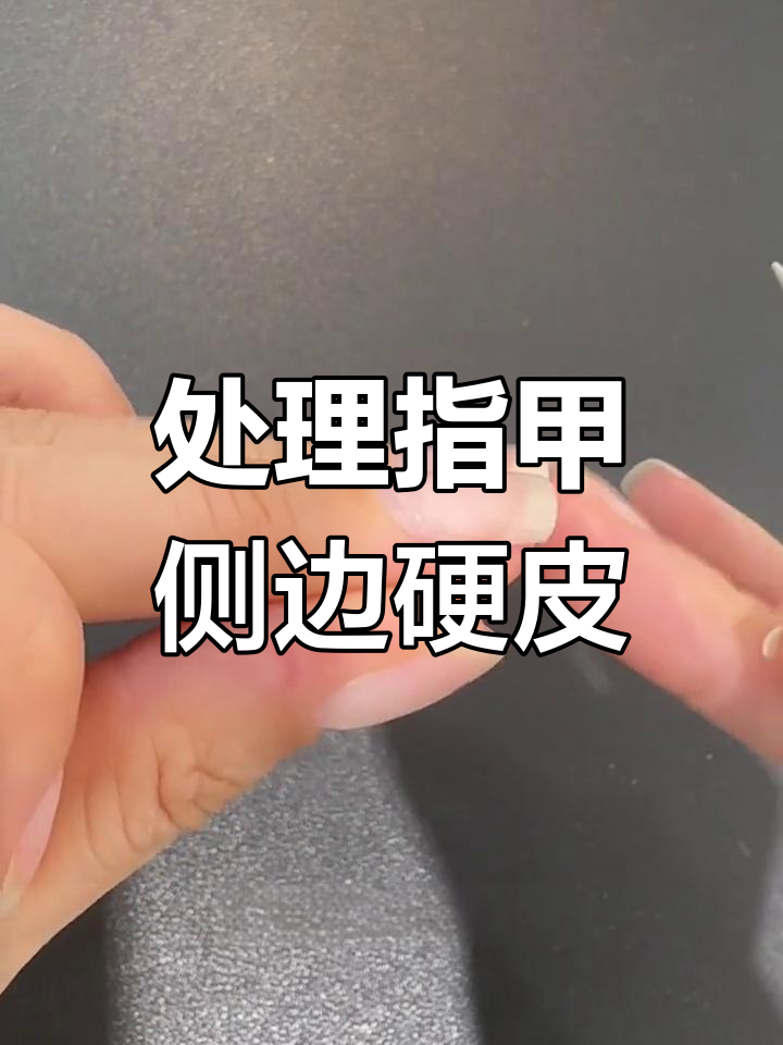 去除指甲两侧硬茧的小技巧