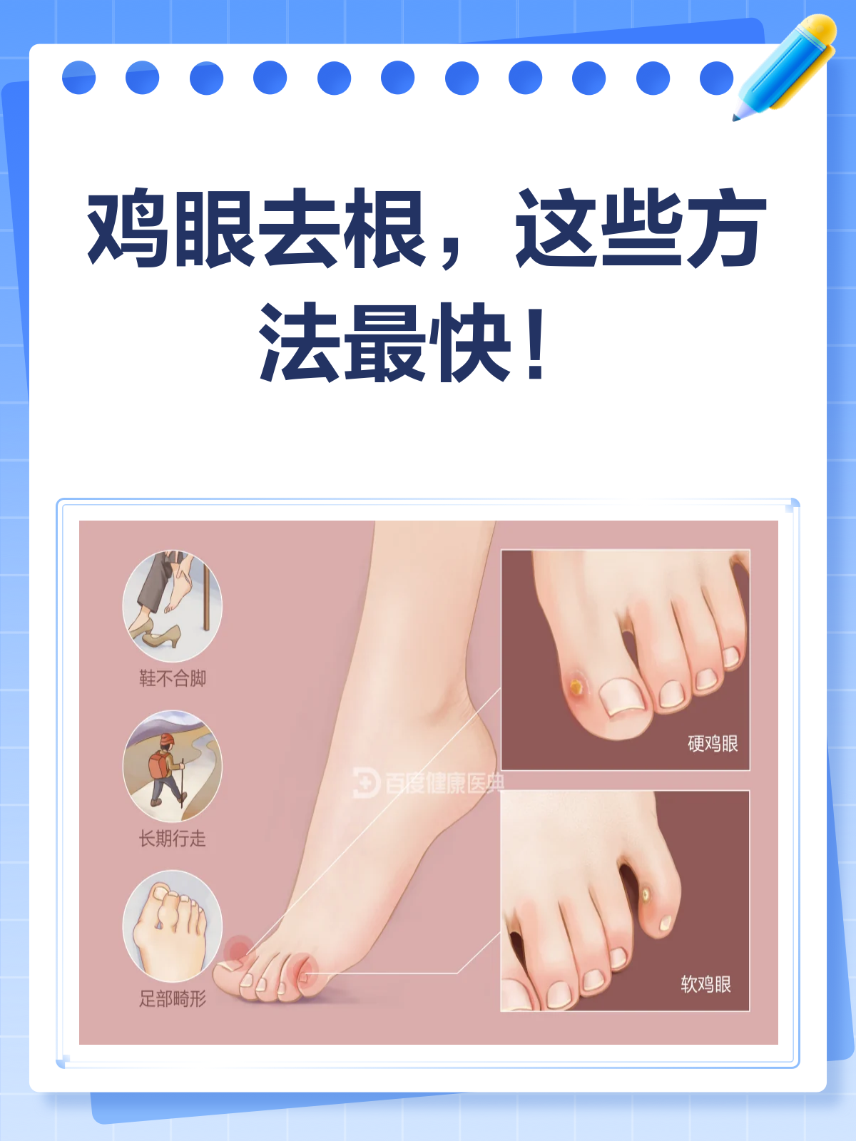 鸡眼去根全攻略!