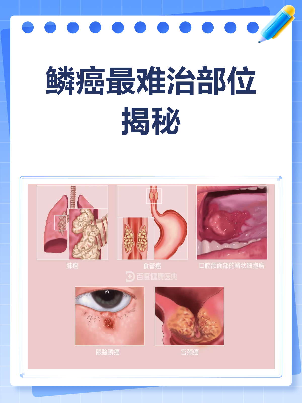 鳞癌哪个部位最难治?一文给你讲清楚!