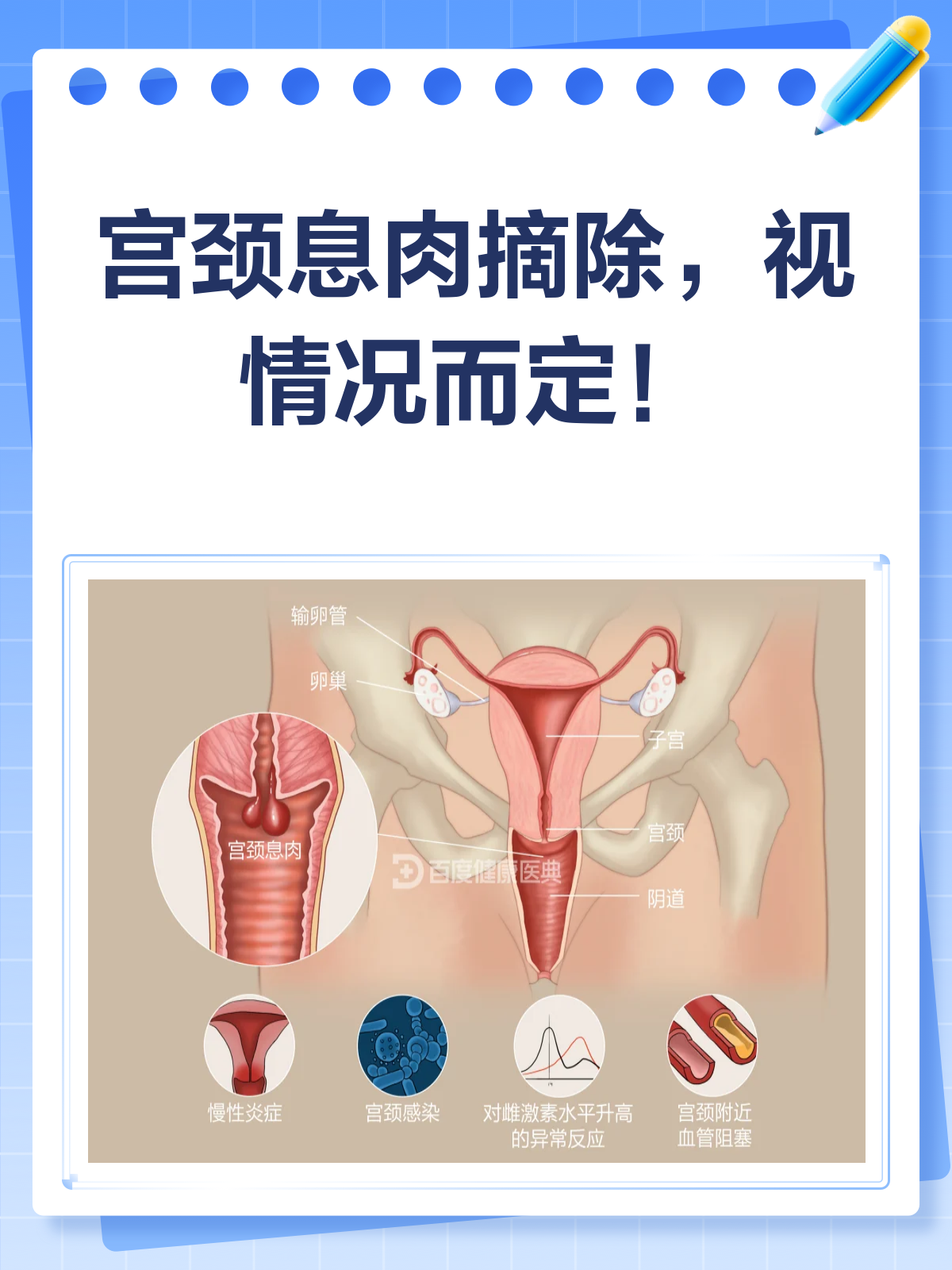 宫颈息肉不建议摘除？听听医生怎么说