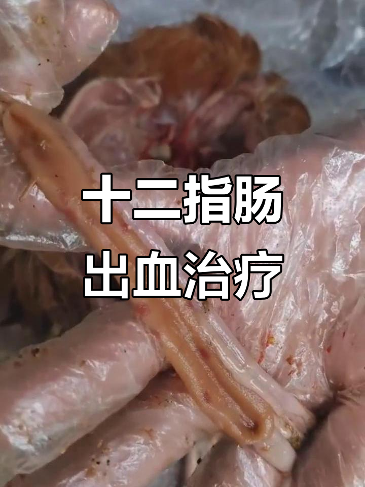 十二指肠出血点揭示肠道问题,治疗方案全解析