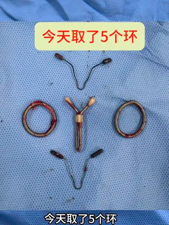 建议女性朋友绝经后及时取环!