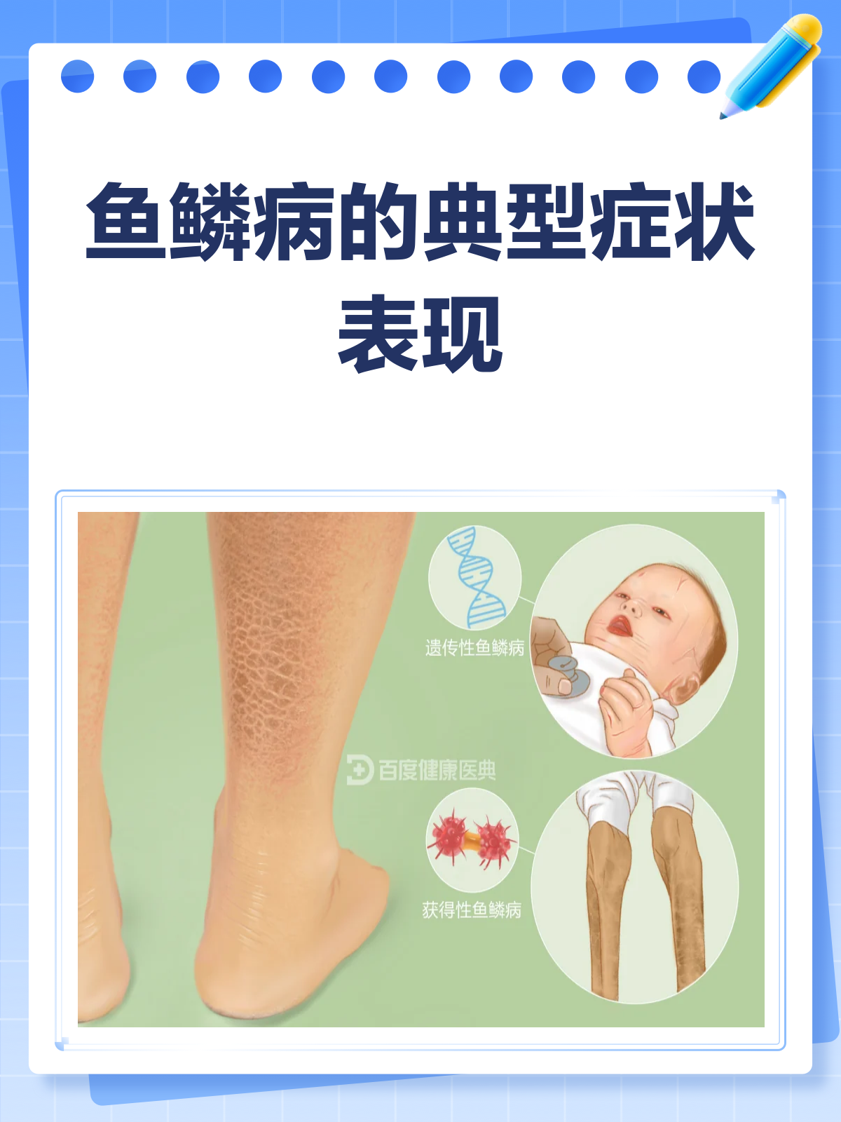 鱼鳞病长啥样？一文带你全面了解