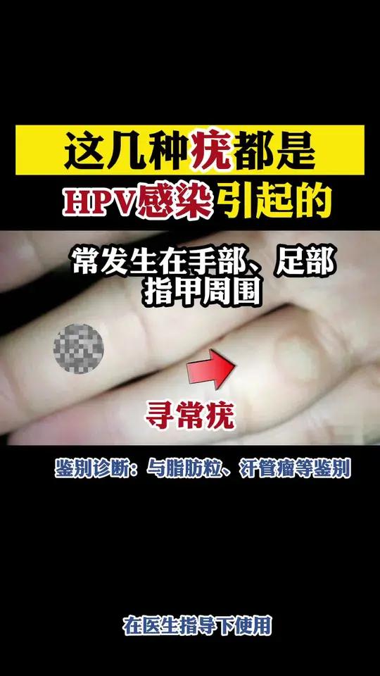 HPV病毒引起的四种皮肤疣,不要再用手去扣,是有传染性的!
