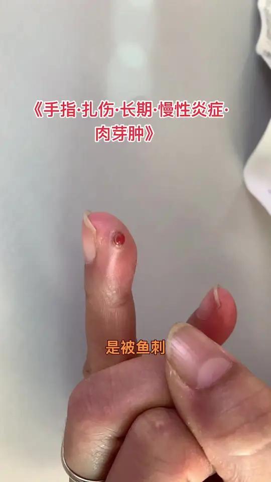 老年人 孕妇 体质弱的人群容易出现这种不收口的肉芽肿手手指扎伤伤口肉芽肿炎症肉芽感染异物创
