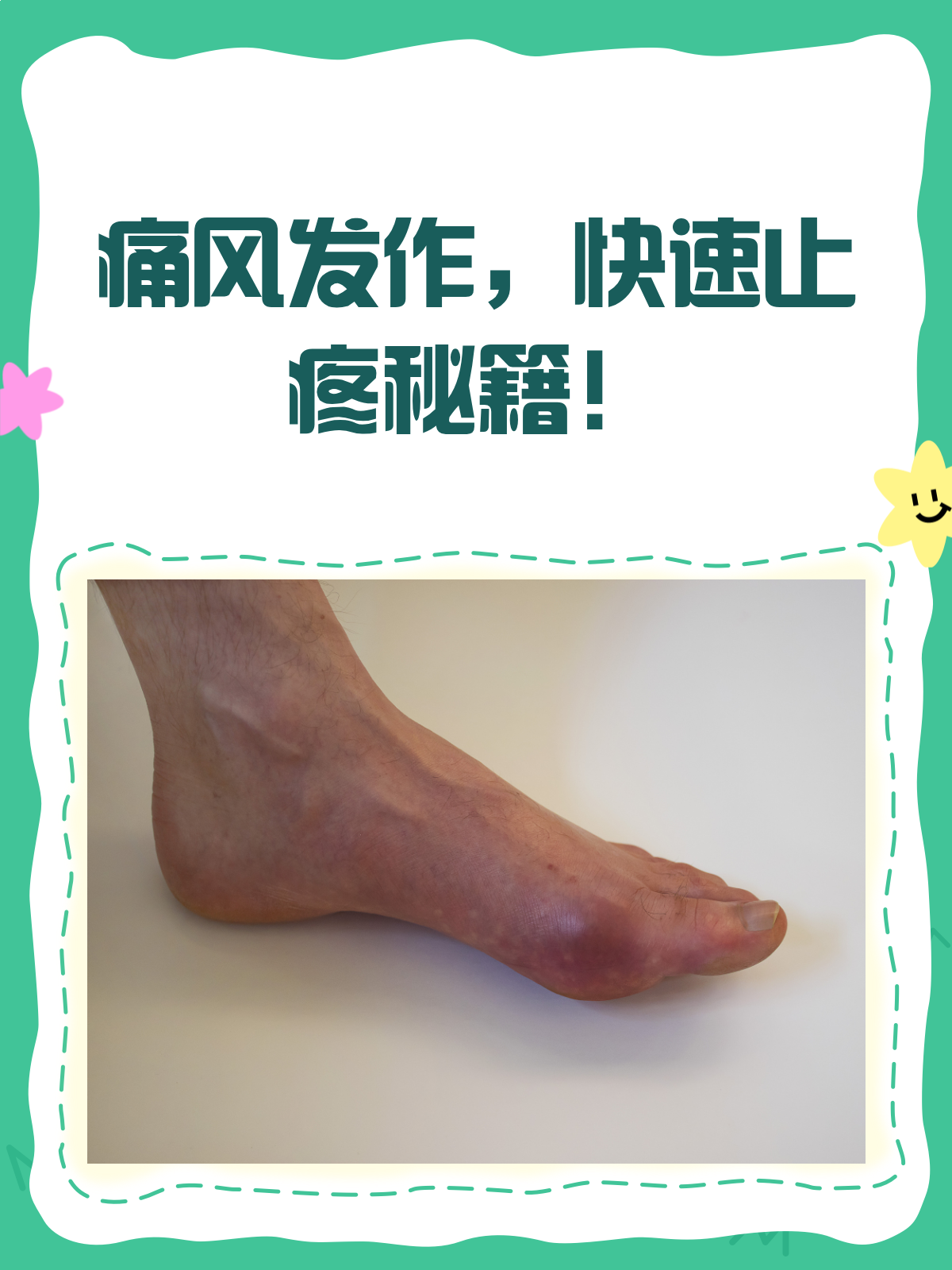 痛风来袭痛不欲生？快速止疼秘籍来啦！