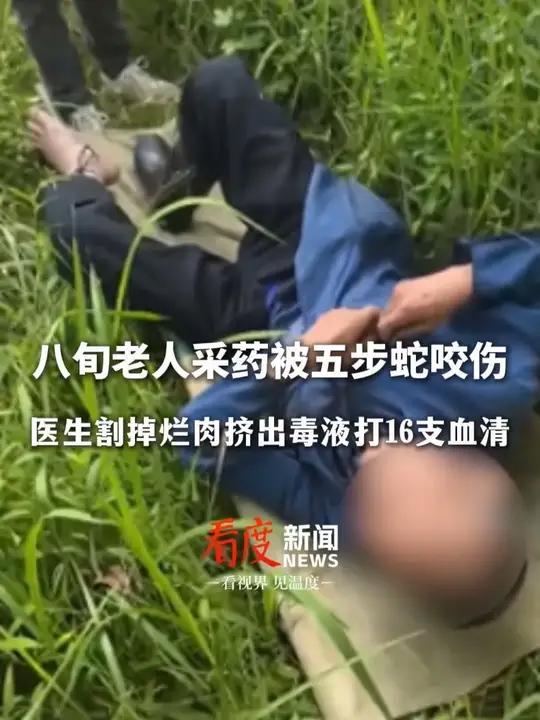 怀化一八旬老人采药被五步蛇咬伤 医生割掉烂肉挤出毒液共打16支血清,已脱离危险!