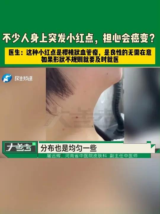 河南郑州,不少人身上突发小红点,担心会癌变?医生:这种小红点是樱桃状血管瘤,是良性的无需在