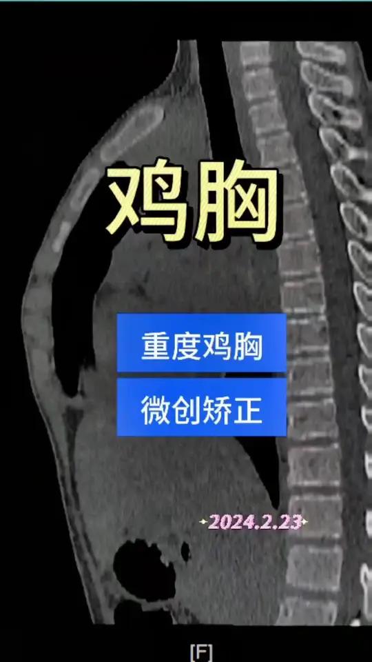 这是一个12岁的男孩,因为从小胸前畸形来就诊,近几年胸前畸形进展明显,有胸闷不适症状,检查