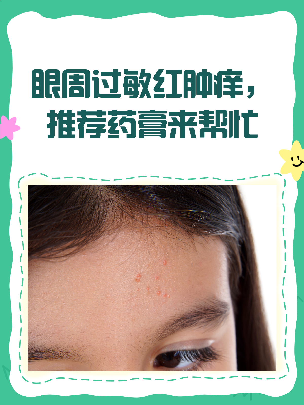 眼周过敏红肿痒？这些药膏来帮忙