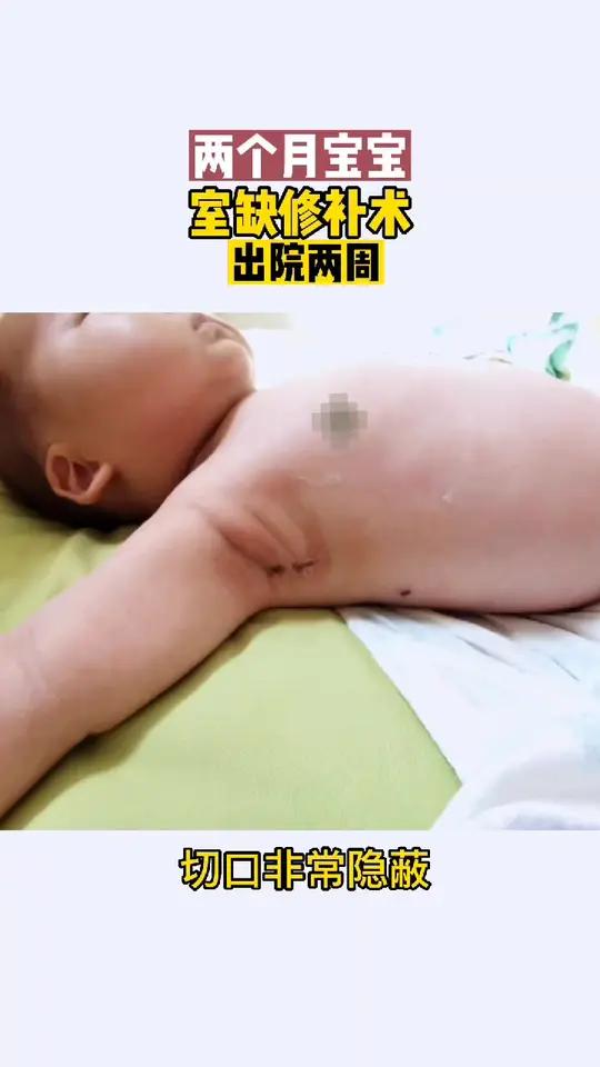 隐蔽的腋下微创切口,长大了没人知道宝宝做过心脏手术。先天性心脏病 腋下微创小切口