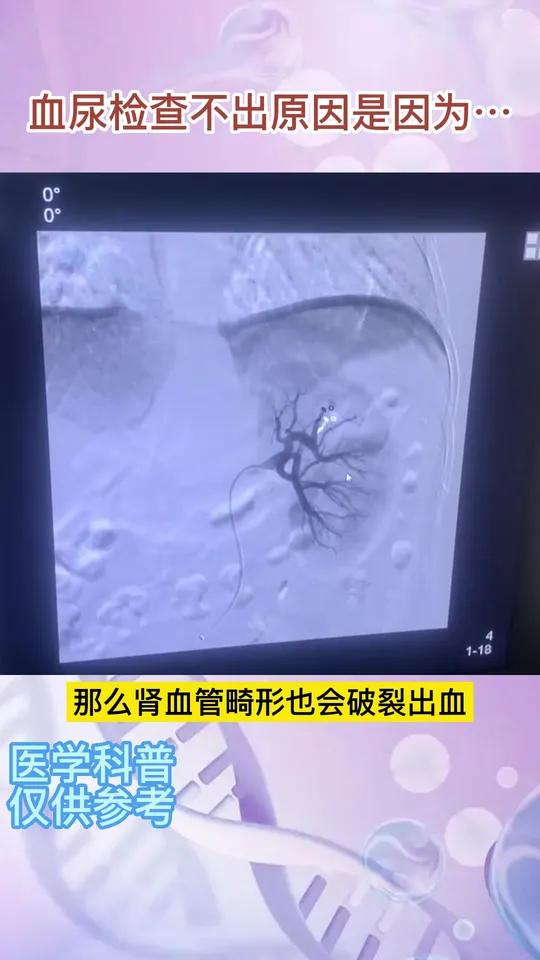 不明原因的血尿可能是 肾血管畸形 引起的破裂出血,需及时就医处理!