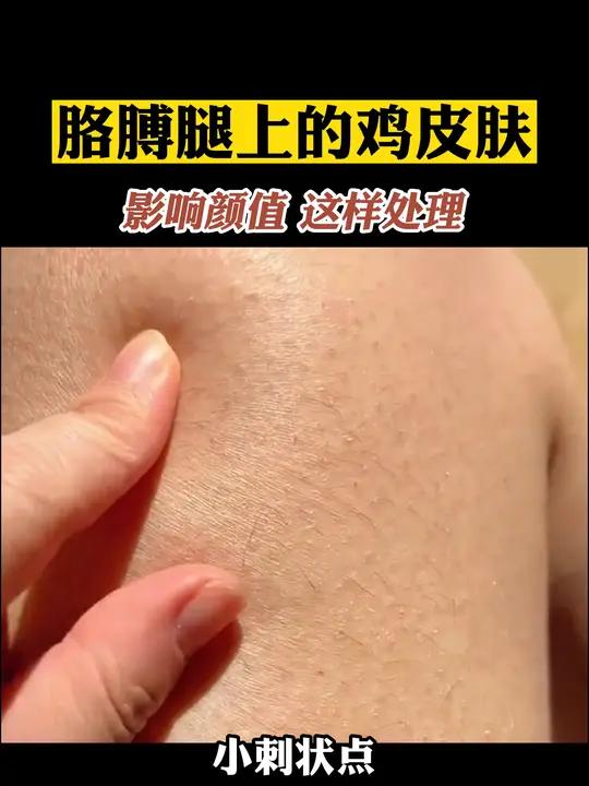 胳膊上腿上密密麻麻的小疙瘩,很影响颜值,可以这样处理 鸡皮肤 毛周角化症
