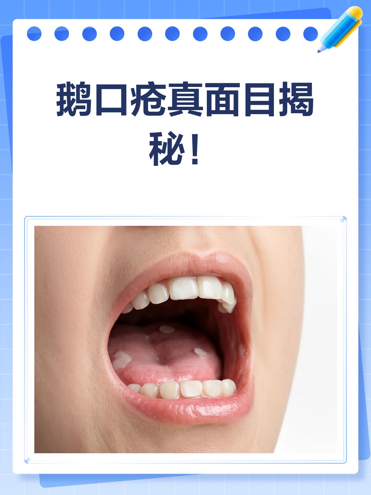 鹅口疮大揭秘！看看它到底长啥样？