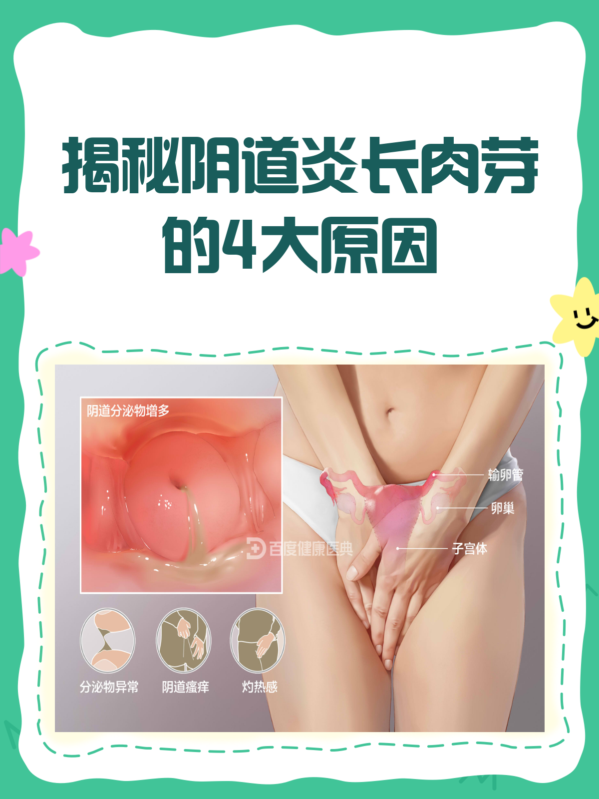 阴道炎为何会长肉芽?一文给你讲明白!