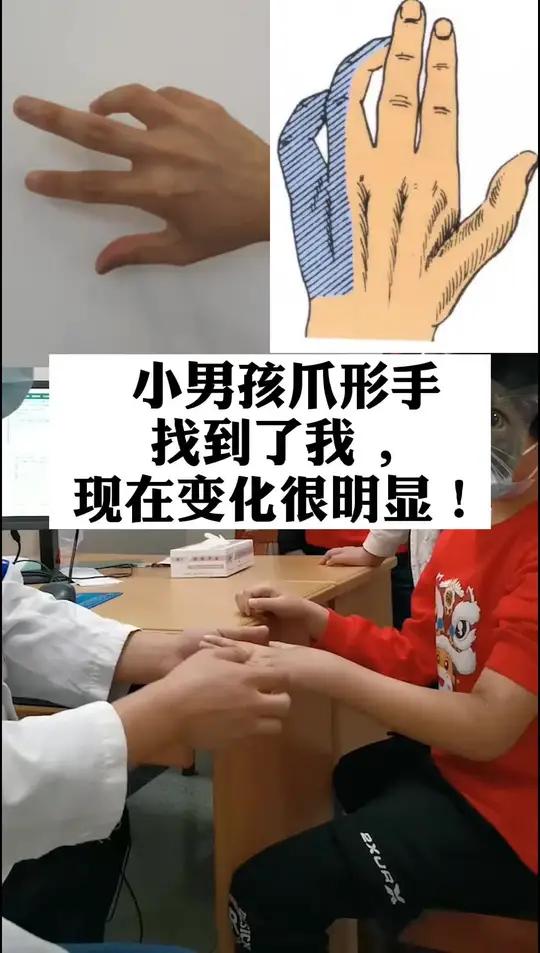 小男孩的手像鸡爪一样,张不开也握不住,千里迢迢找到了我,现在变化很明显