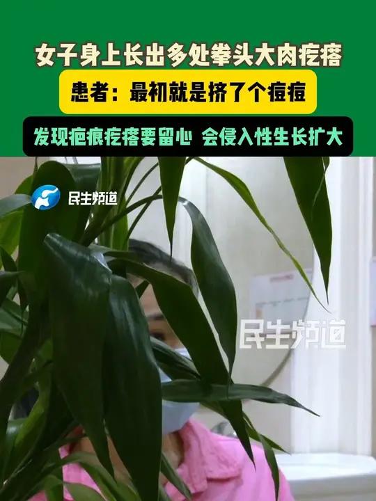 女子身上长出多处拳头大肉疙瘩；患者：最初就是挤了个痘痘；发现疤痕疙瘩要留心 会侵入性生长扩