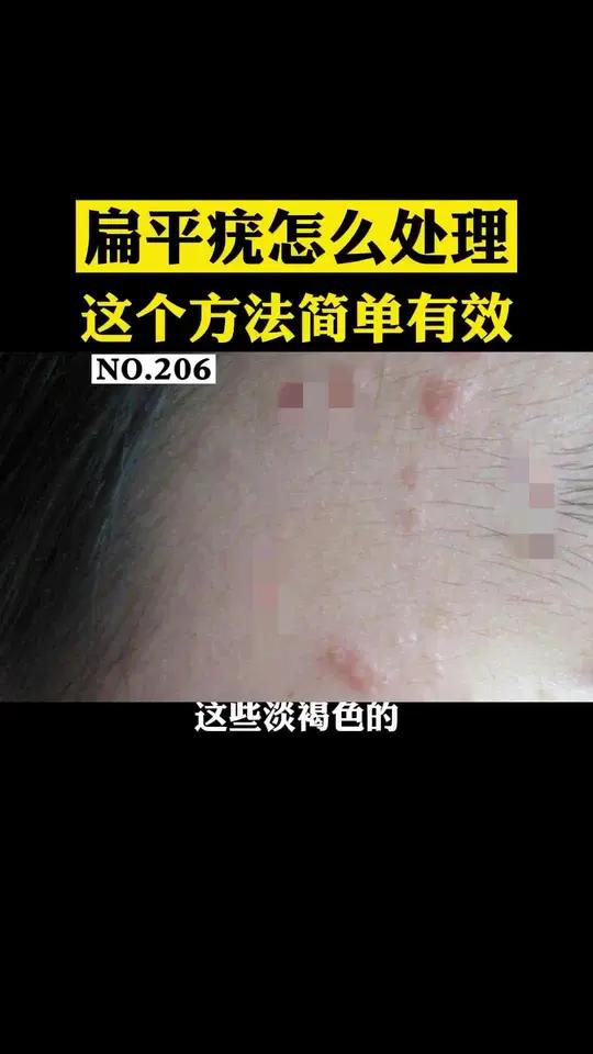 脸上或者手上长这种扁平的小丘疹,可能是HPV感染引起的!