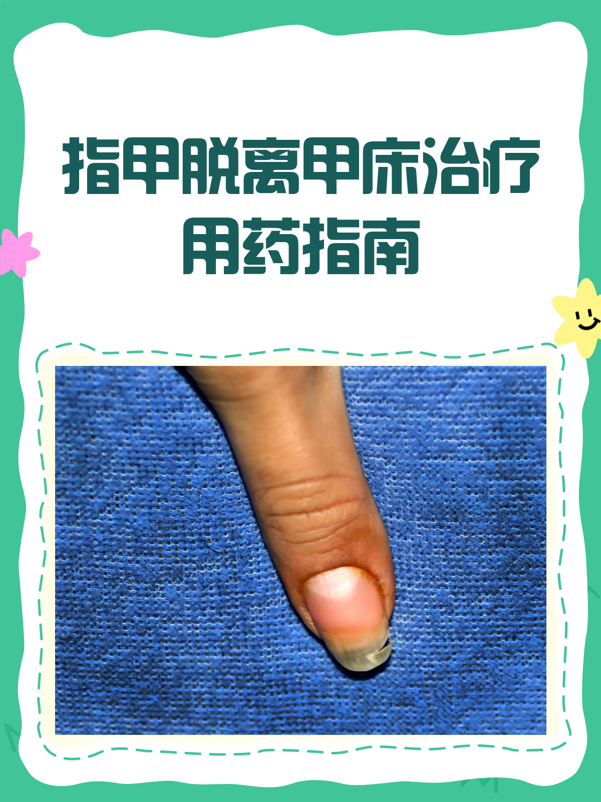 指甲脱离甲床?别急,对症用药是关键!